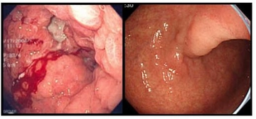 Ülser Kanser Belirtileri ve Tedavisi