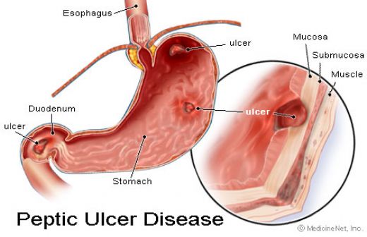 Duodenal lser