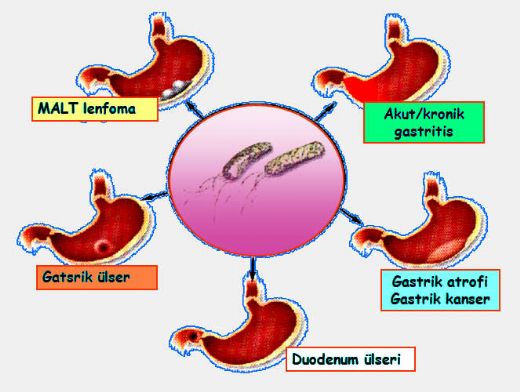 lser Gastrit