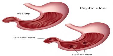 Duodenal lser